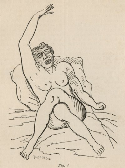 Hysterisk epilepsi, anfald, forvridninger, fig. 1 fra 