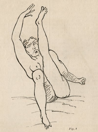 Hysterisk epilepsi, anfald, forvridninger, fig. 2 fra 