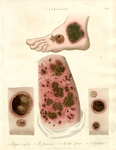 Patologiske hudsygdomme - Pityria, impetigo og syfilis af John Pass