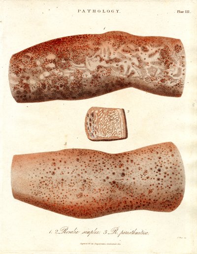 Udbrud i huden - Roseola simplex og Roseola paristhmitica af John Pass