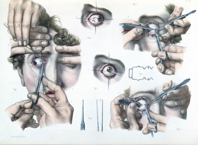 Operation af en strabismus, plade fra "Traite Complet de l