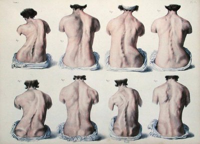 Spinal deformiteter, plade fra 