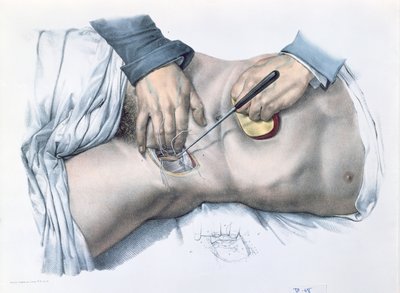 Binding af en arterie, tallerken fra 