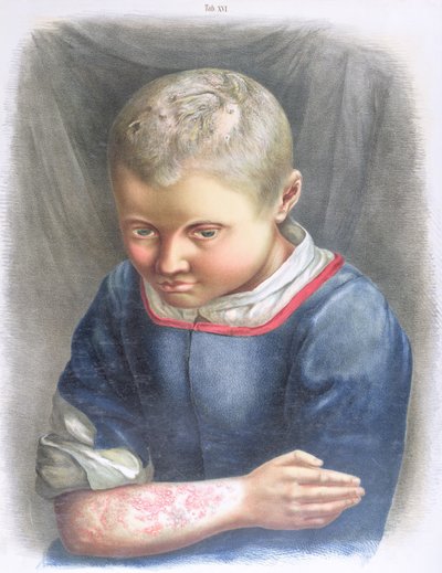 Favus, fra en bog af Daniel Cornelius Danielssen (1815-94) 1892 af Norwegian School
