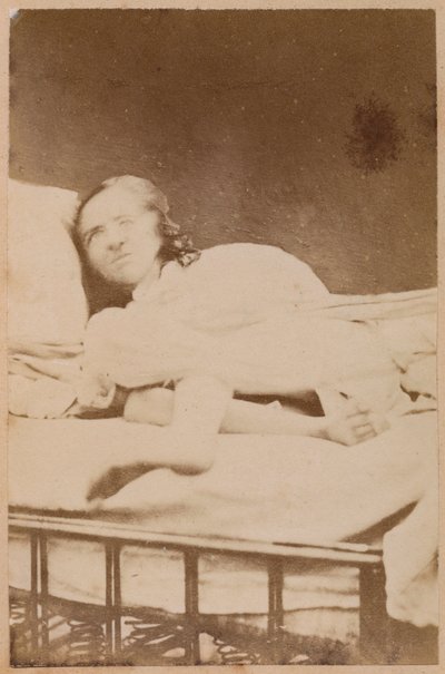 Hysterisk epilepsi, forvridninger, plade XXXVIII fra 