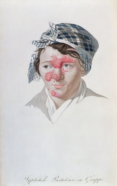 Syfiliske klyngepustler, fra en bog af Baron Jean Louis Alibert (1768-1837) 1838 af Salvadore Tresca