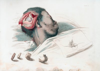 Visning af sår i kraniet efter trephination og fjernelse af knust knoglestykke nederst til venstre, 1821 af Thomas Landseer
