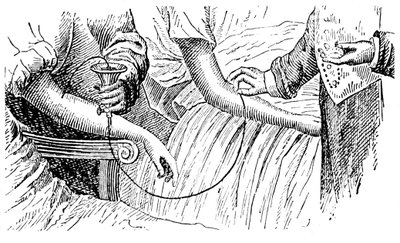 Blodtransfusion, c1880 af Unbekannt