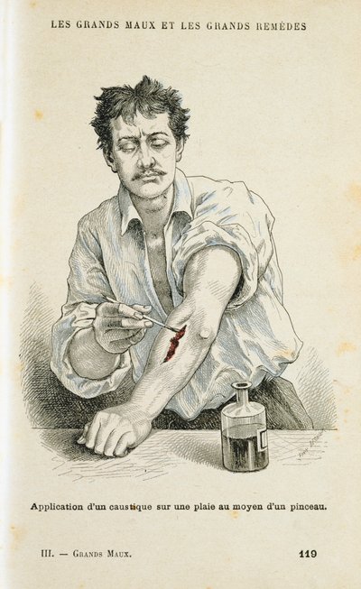 Maling af et sår med en antiseptisk opløsning, c1890 af Unbekannt