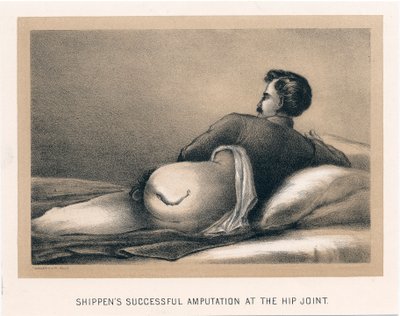 Sender succesfuld amputation ved hofteleddet, amerikansk borgerkrig, 1865 af Unbekannt