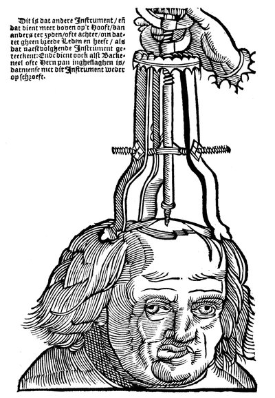 Trephination, 1593 af Unbekannt