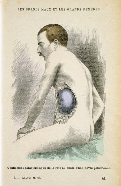 Typisk forstørret milt hos en malariapatient, c1890 af Unbekannt