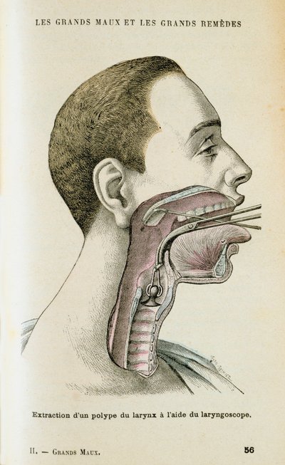 Brug af et laryngoskop til at hjælpe med at fjerne en polyp fra halsen, c1890 af Unbekannt