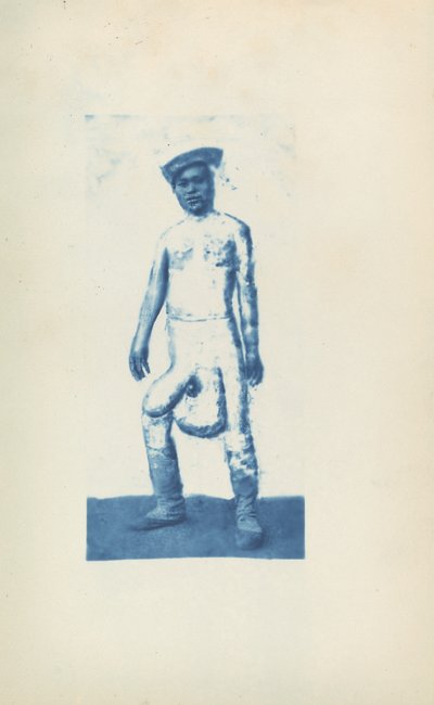 Elefantiasis af Unknown 19th Century