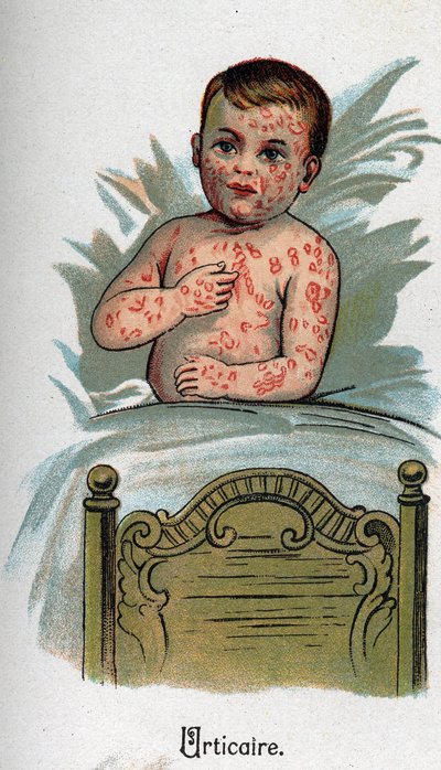 Børnesygdomme: Nældefeber. I "Den nye naturmedicin"" af F.E. Bilz. af Unknown artist