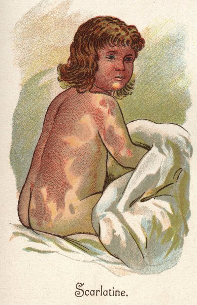Børnesygdomme: Skarlagensfeber. I "Den nye naturlige medicin"" af F.E. Bilz. af Unknown artist