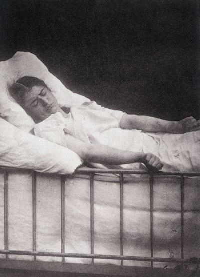 Hystero Epilepsie - Stivkrampeangreb i "" Fotografisk ikonografi af Salpétrière: service of Mr. Charcot"" af Paul Regnard og Bourneville af Unknown artist
