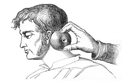 Saignee-lokaliteter - påføring af igler med et æble - indgravering i "La Santo Universelle - Medicinsk vejledning for familier"" 1852 af Unknown artist