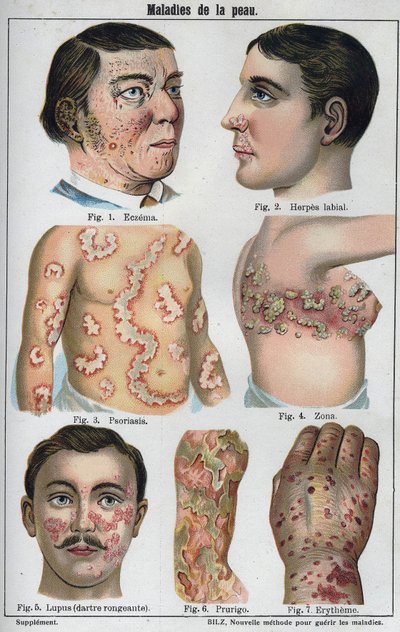 Hudsygdomme: Eksem, labial herpes, psoriasis, helvedesild, lapus (rådnende darter), prurigo, erytem." Den nye naturlige medicin”” af F.E. Bilz. af Unknown artist