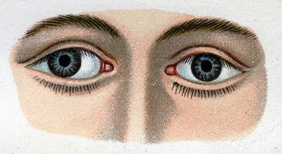 Strabismus divergerende. "Den nye naturlige medicin" af F.E. Bilz. af Unknown artist