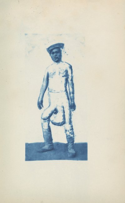 Elefantiasis, ca. 1870
