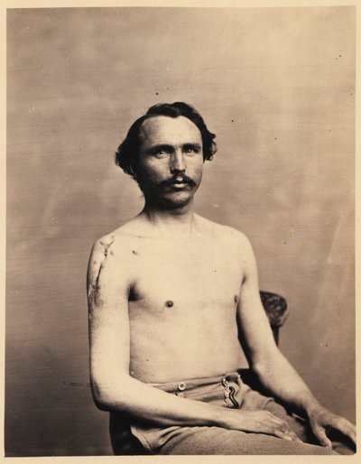 Menig Adolph Zirsse, vellykket mellemliggende excision af hovedet og to en halv tomme af skaftet på højre humerus, fra det fotografiske katalog over den kirurgiske afdeling af William Bell