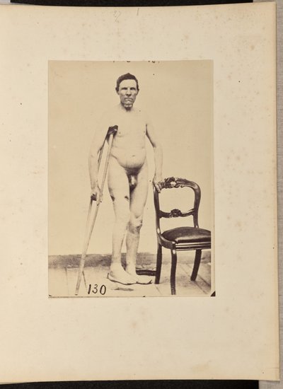 Konsolideret skudfraktur i den midterste tredjedel af højre lårbensknogle af William H. Bell