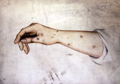 Studie af en underarm med hudtilstand, ca. 1850 (akvarel på papir) af William Lover