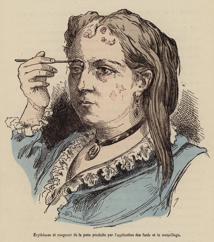 Kvinde med hududslæt og rødme forårsaget af brug af makeup (farvet gravering) af (after) French School