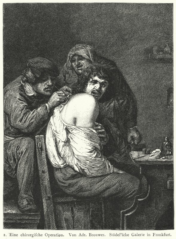 Rygoperationen af Adriaen (after) Brouwer