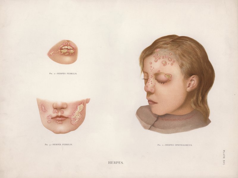 Hudsygdomme: Herpes (farve litho) af English School