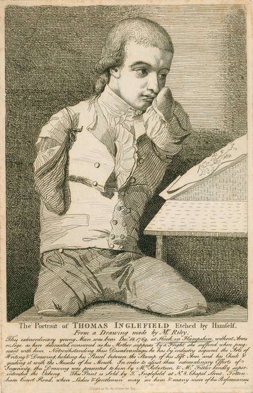 Thomas Inglefield, født 18. december 1769 i Hook, Hampshire, uden arme eller ben af English School