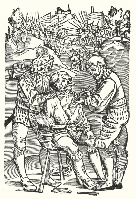 Barberkirurg, der fjerner en pil (gravering) af European School