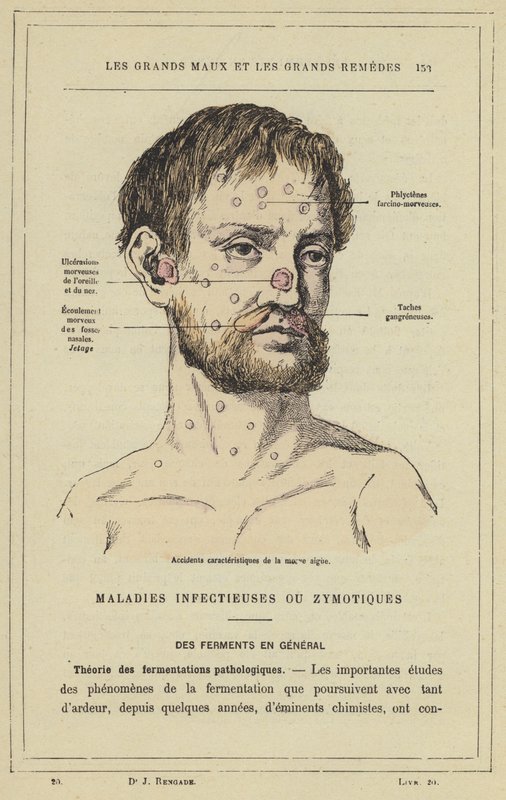 Karakteristiske strøg af akut snot (farve litho) af French School