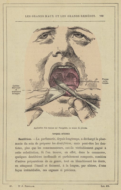 Påføring af et topisk på tonsillen ved hjælp af børsten (farve litho) af French School