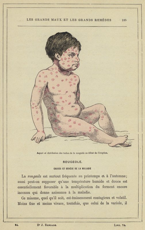 Udseende og fordeling af mæslingepletter ved begyndelsen af ​​udbruddet (farve litho) af French School