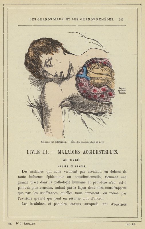 Asfyksi ved nedsænkning, tilstand af lungerne ved drukning (farve litho) af French School
