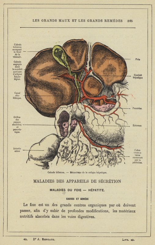 Galdesten, Mekanisme af hepatisk kolik (farve litho) af French School