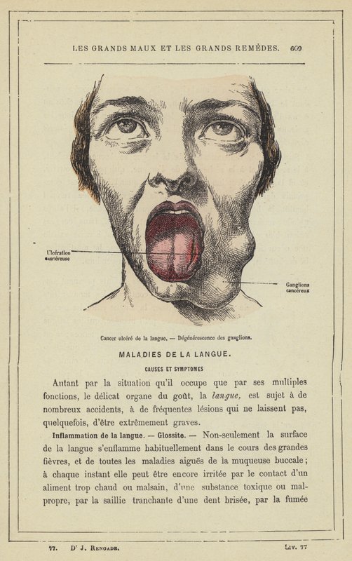 Sårkræft i tungen, Degeneration af lymfeknuder (farve litho) af French School