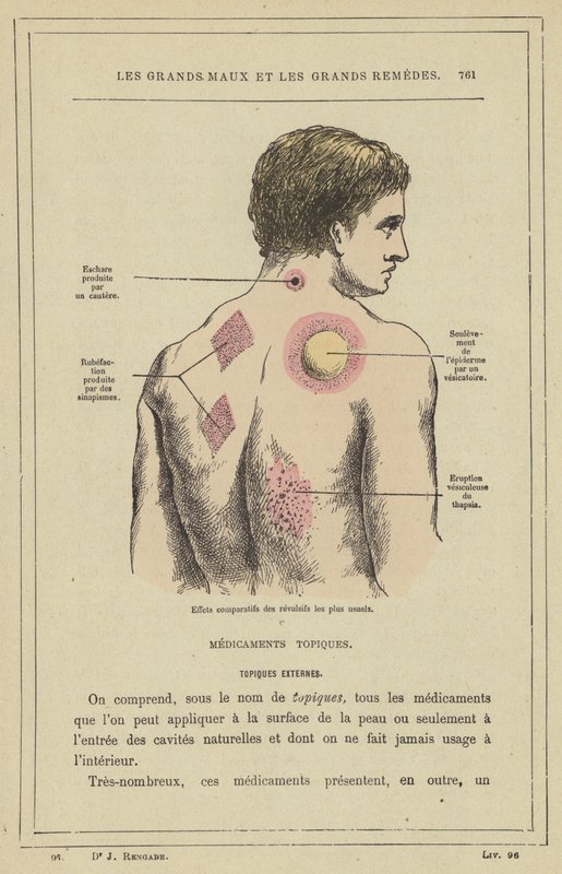Sammenlignende virkninger af de mest almindelige afskrækningsmidler (farve litho) af French School
