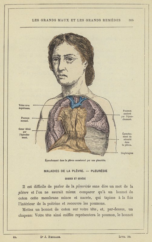 Effusion i lungehinden forårsaget af lungehindebetændelse (farve litho) af French School