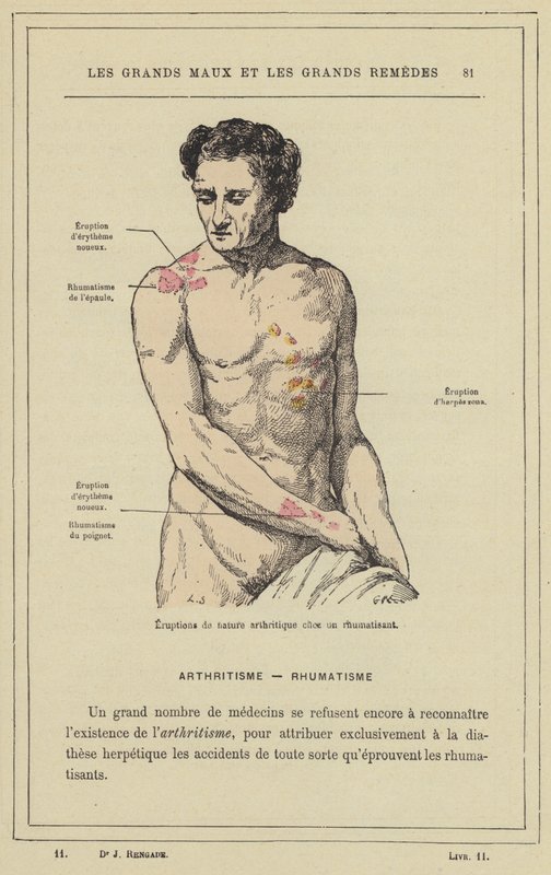 Udbrud af arthritisk karakter hos en gigtpatient (farve litho) af French School