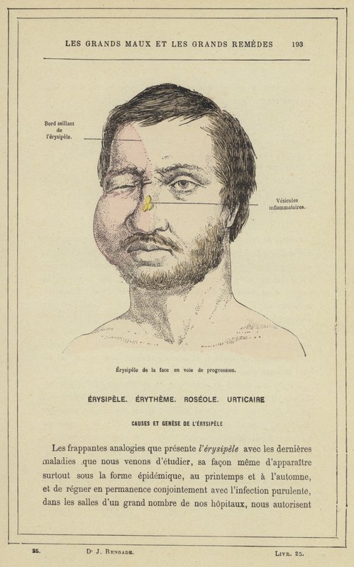 Progressive facial erysipelas (farve litho) af French School