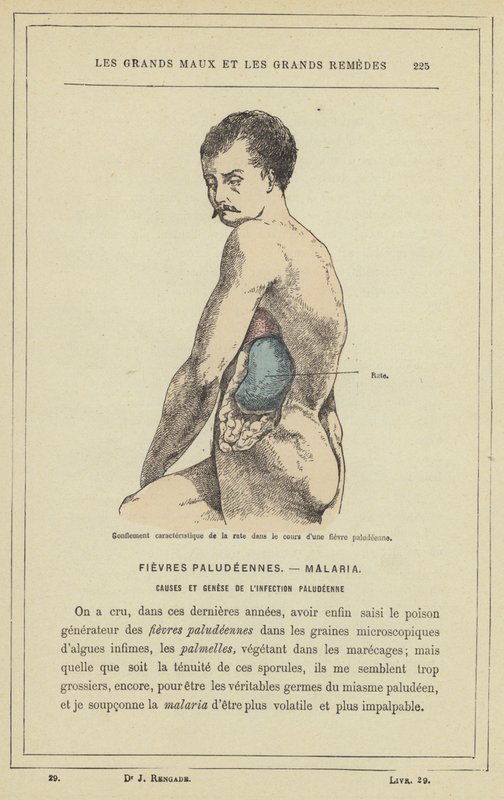 Karakteristisk hævelse af milten i løbet af malariafeber (farve litho) af French School