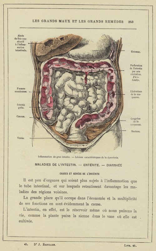 Betændelse i tyktarmen, læsioner karakteristiske for dysenteri (farve litho) af French School