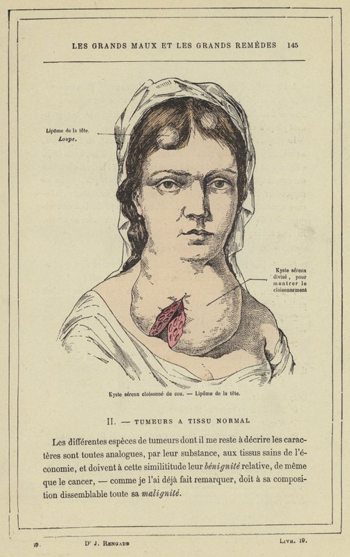 Cloisonne serøs cyste i halsen, Lipoma i hovedet (farve litho) af French School