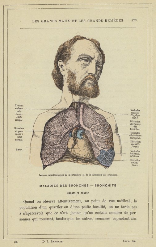Læsioner karakteristiske for bronkitis og bronchial dilatation (farve litho) af French School