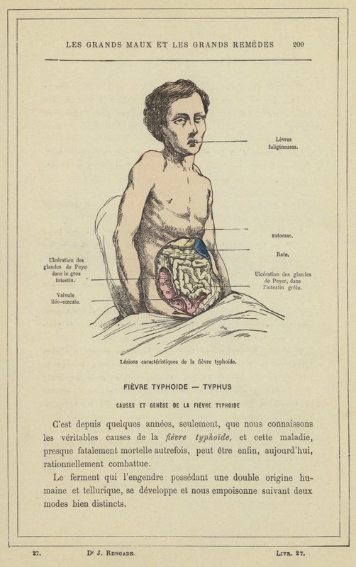 Karakteristiske læsioner af tyfusfeber (farve litho) af French School