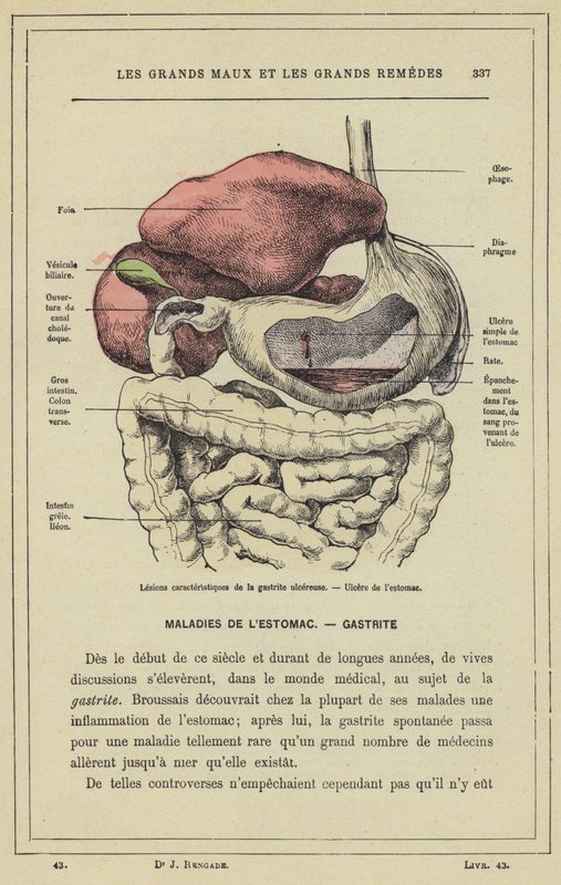 Karakteristiske læsioner af ulcerøs gastritis, mavesår (farve litho) af French School