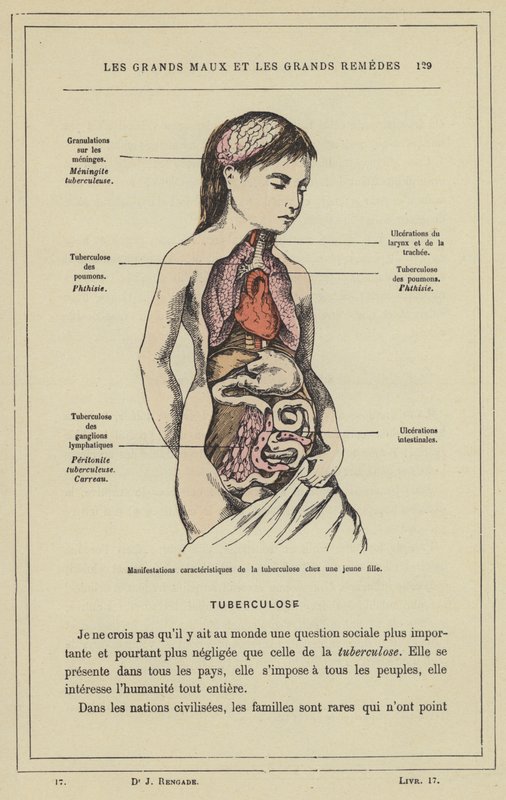 Karakteristiske manifestationer af tuberkulose hos en ung pige (farve litho) af French School